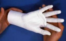 Abguss der Hand
